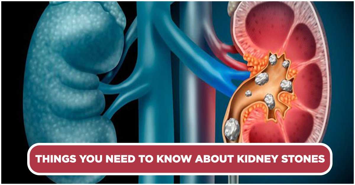 Things you need to know about Kidney Stones