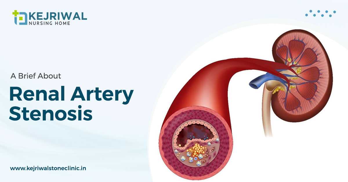 Your Best Nephrologist For Renal Artery Stenosis