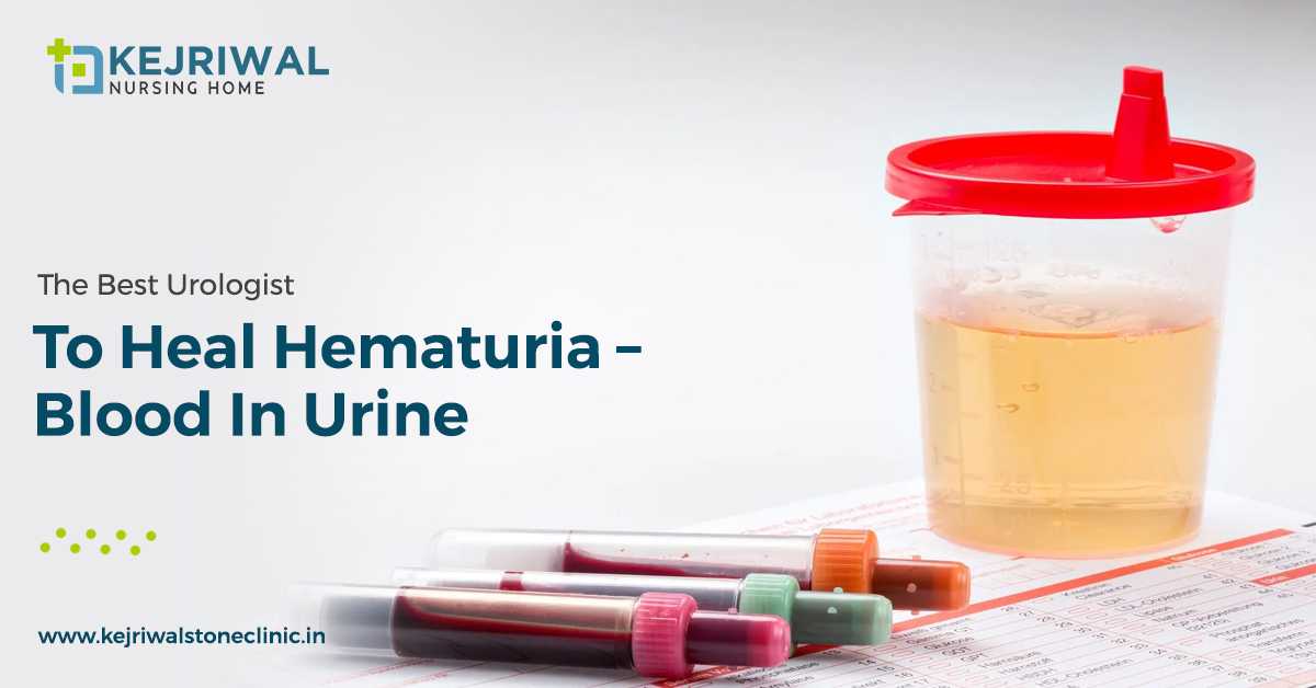 The Best Urologist To Heal Hematuria – Blood In Urine