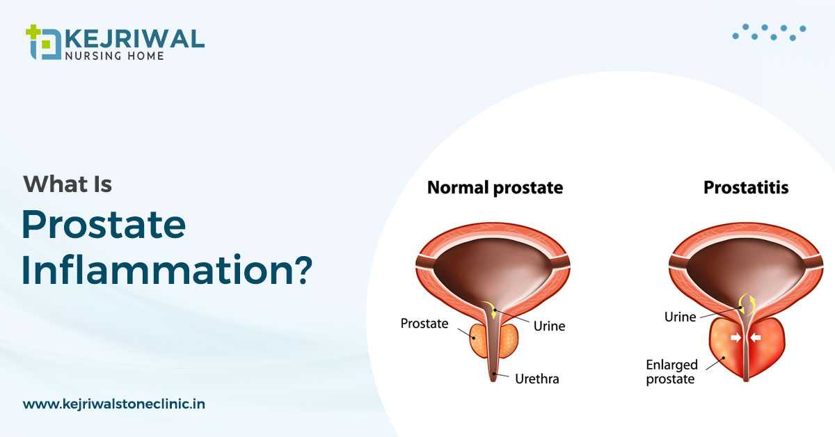 Prostatitis – Inflammation Of The Prostate Gland