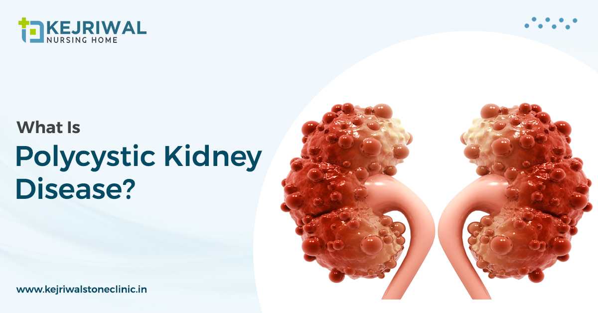 Heal Polycystic Kidney Disease – A Genetic Condition