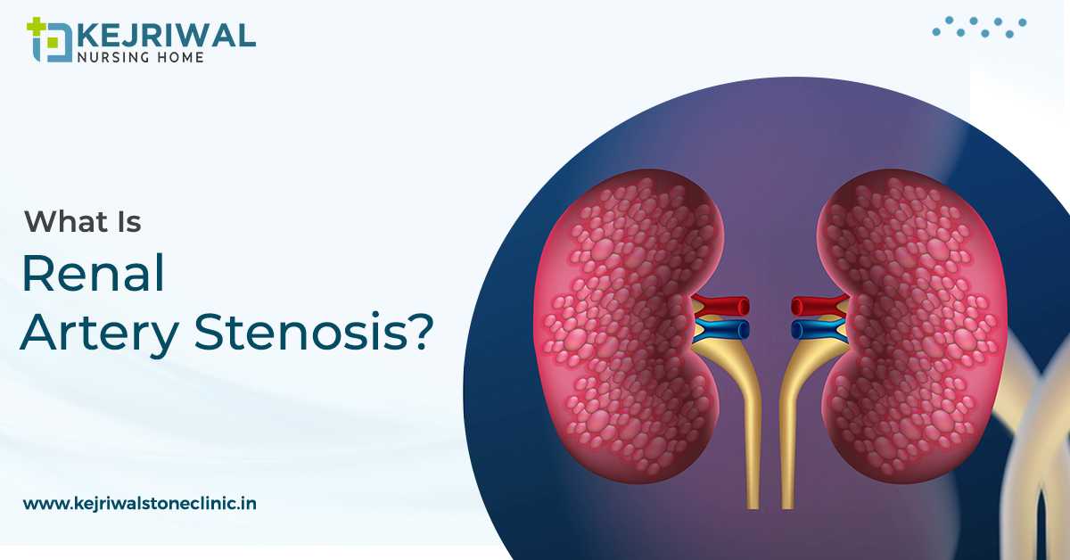 Renal Artery Stenosis – Here’s What To Know