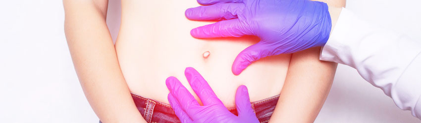 Hernia Surgery in Siliguri